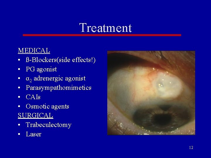 Treatment MEDICAL • ß-Blockers(side effects!) • PG agonist • α 2 adrenergic agonist • Treatment MEDICAL • ß-Blockers(side effects!) • PG agonist • α 2 adrenergic agonist •