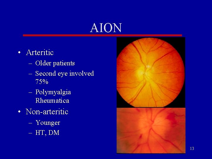 AION • Arteritic – Older patients – Second eye involved 75% – Polymyalgia Rheumatica AION • Arteritic – Older patients – Second eye involved 75% – Polymyalgia Rheumatica