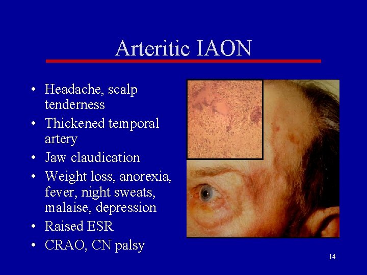 Arteritic IAON • Headache, scalp tenderness • Thickened temporal artery • Jaw claudication • Arteritic IAON • Headache, scalp tenderness • Thickened temporal artery • Jaw claudication •
