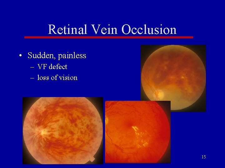 Retinal Vein Occlusion • Sudden, painless – VF defect – loss of vision 15 Retinal Vein Occlusion • Sudden, painless – VF defect – loss of vision 15