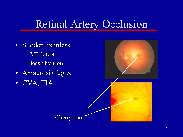 Retinal Artery Occlusion • Sudden, painless – VF defect – loss of vision • Retinal Artery Occlusion • Sudden, painless – VF defect – loss of vision •