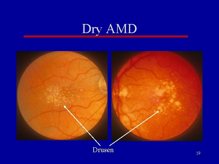 Dry AMD Drusen 19 Dry AMD Drusen 19