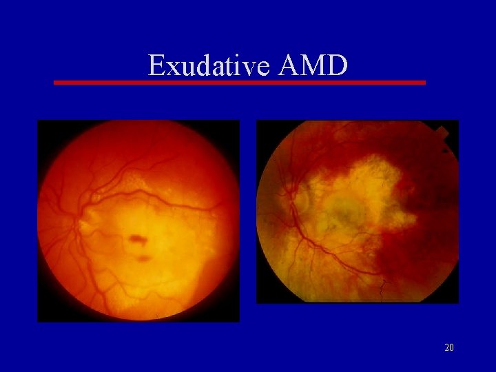 Exudative AMD 20 Exudative AMD 20