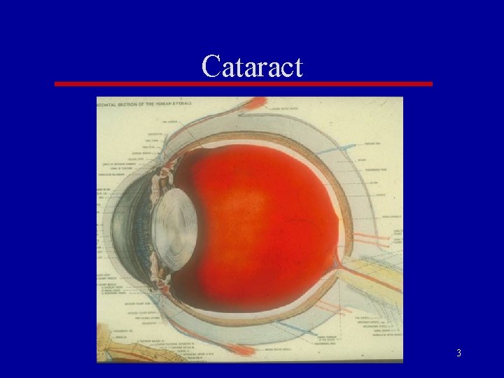 Cataract 3 Cataract 3
