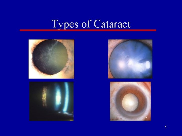 Types of Cataract 5 Types of Cataract 5