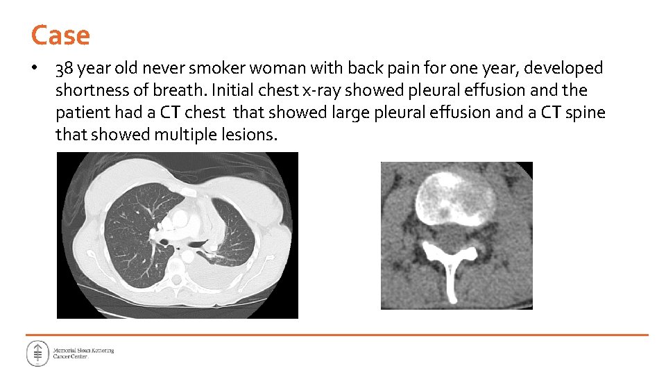 Case • 38 year old never smoker woman with back pain for one year, Case • 38 year old never smoker woman with back pain for one year,