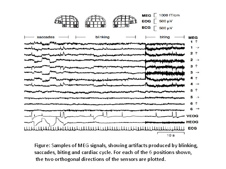 Figure: Samples of MEG signals, showing artifacts produced by blinking, saccades, biting and cardiac