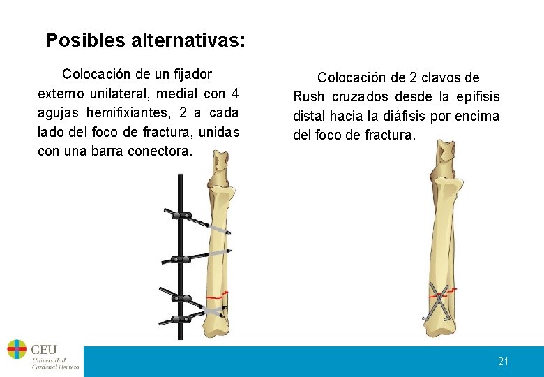 Posibles alternativas: Colocación de un fijador externo unilateral, medial con 4 agujas hemifixiantes, 2