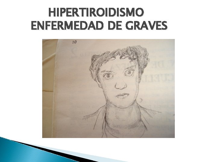 HIPERTIROIDISMO ENFERMEDAD DE GRAVES 