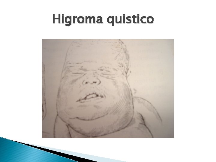 Higroma quistico 