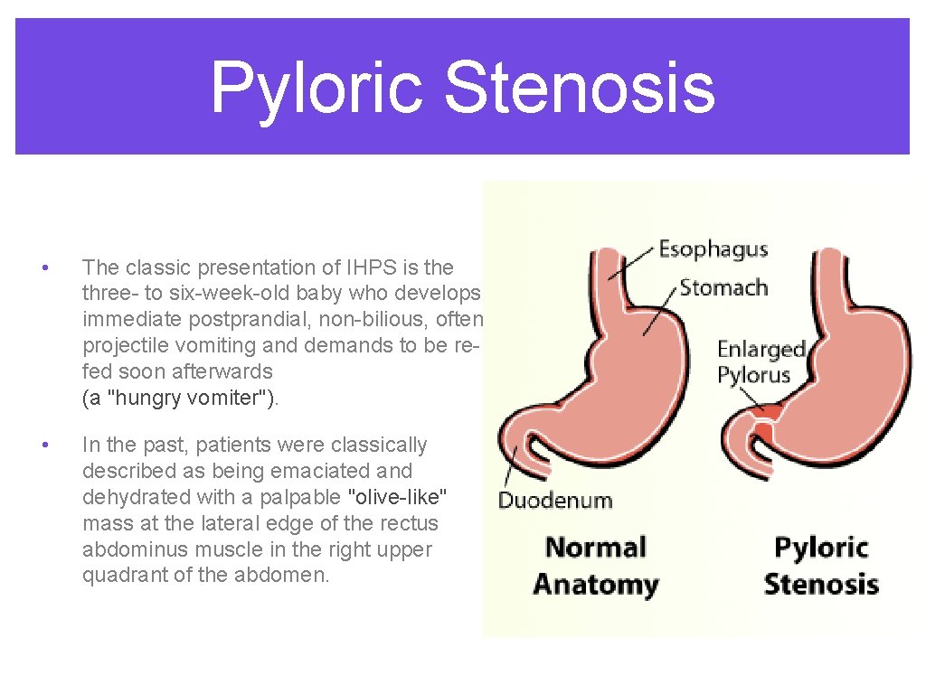 Pyloric Stenosis • The classic presentation of IHPS is the three- to six-week-old baby Pyloric Stenosis • The classic presentation of IHPS is the three- to six-week-old baby