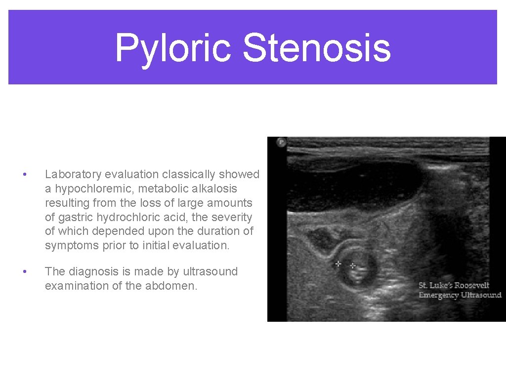 Pyloric Stenosis • Laboratory evaluation classically showed a hypochloremic, metabolic alkalosis resulting from the Pyloric Stenosis • Laboratory evaluation classically showed a hypochloremic, metabolic alkalosis resulting from the