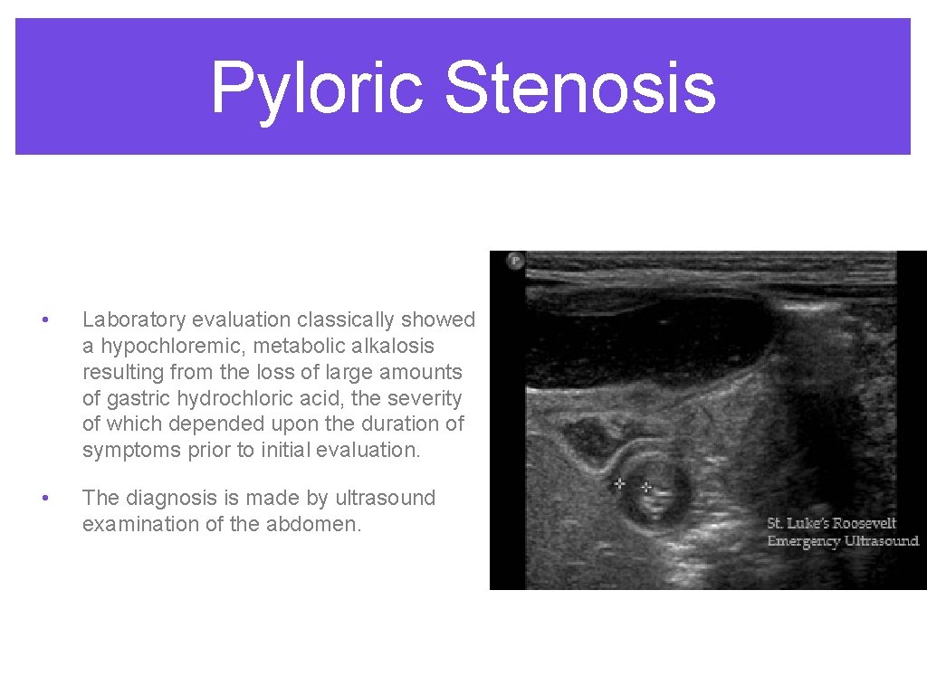 Pyloric Stenosis • Laboratory evaluation classically showed a hypochloremic, metabolic alkalosis resulting from the