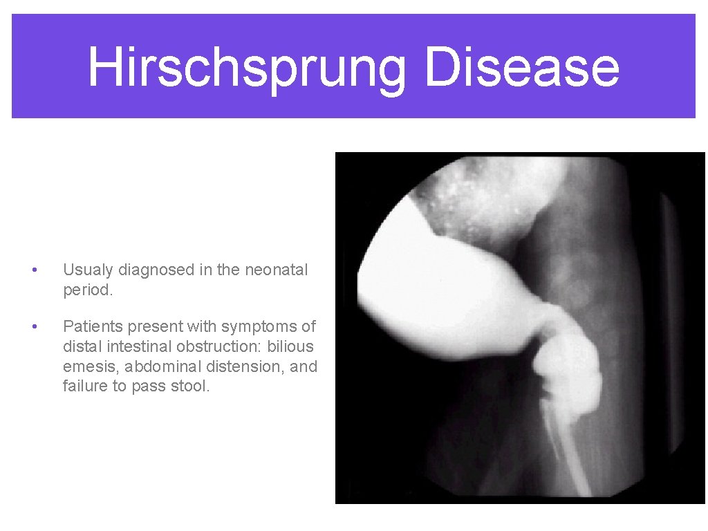 Hirschsprung Disease • Usualy diagnosed in the neonatal period. • Patients present with symptoms Hirschsprung Disease • Usualy diagnosed in the neonatal period. • Patients present with symptoms