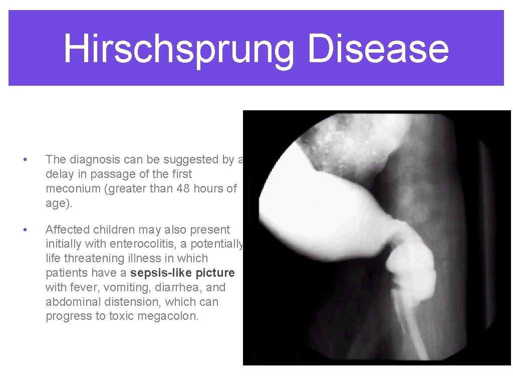 Hirschsprung Disease • The diagnosis can be suggested by a delay in passage of