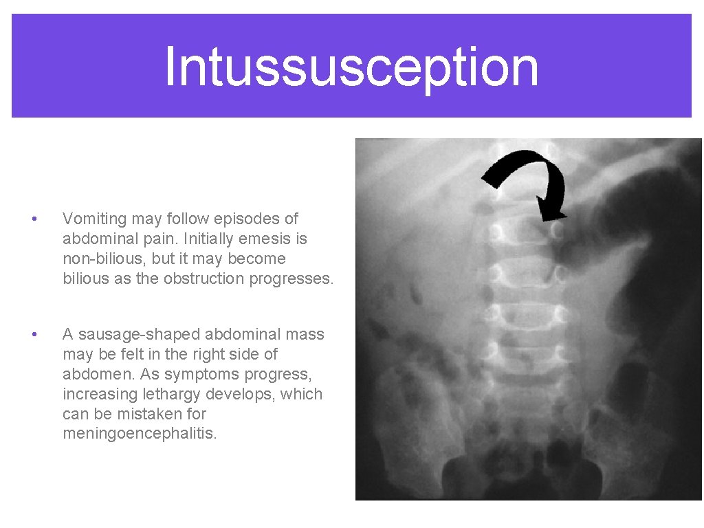 Intussusception • Vomiting may follow episodes of abdominal pain. Initially emesis is non-bilious, but Intussusception • Vomiting may follow episodes of abdominal pain. Initially emesis is non-bilious, but