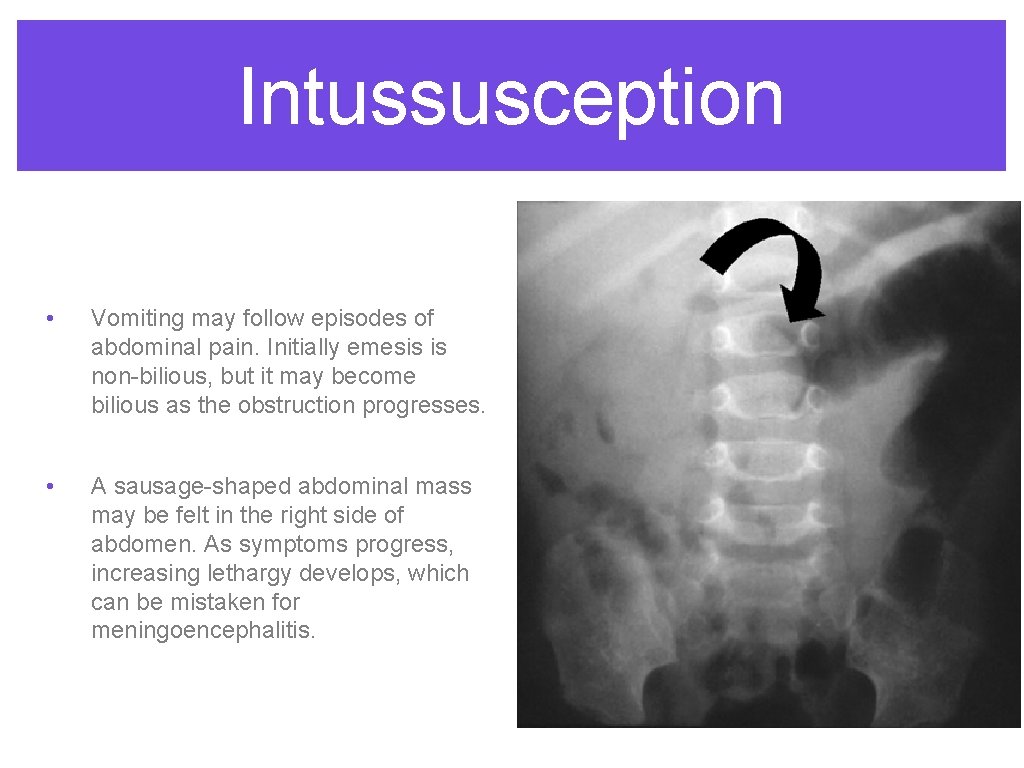 Intussusception • Vomiting may follow episodes of abdominal pain. Initially emesis is non-bilious, but