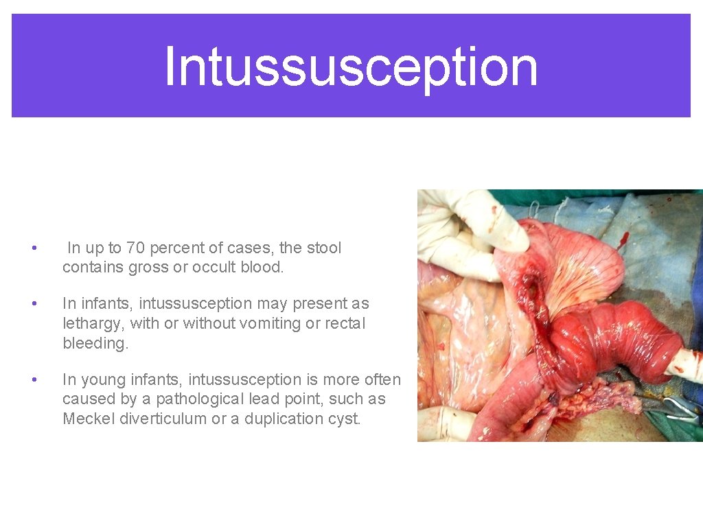 Intussusception • In up to 70 percent of cases, the stool contains gross or
