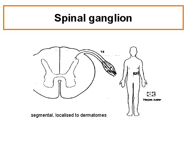 Spinal ganglion segmental, localised to dermatomes 
