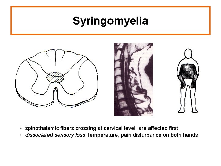 Syringomyelia • spinothalamic fibers crossing at cervical level are affected first • dissociated sensory
