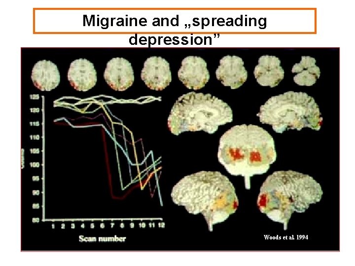 Migraine and „spreading depression” Woods et al. 1994 
