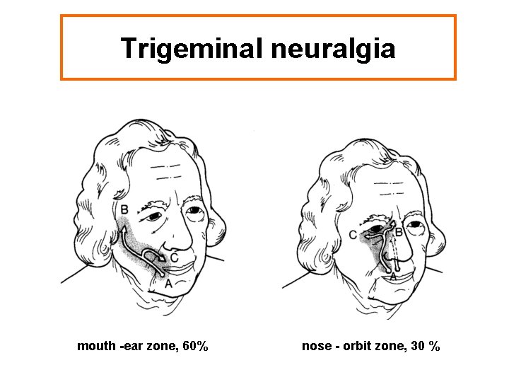 Trigeminal neuralgia mouth -ear zone, 60% nose - orbit zone, 30 % 