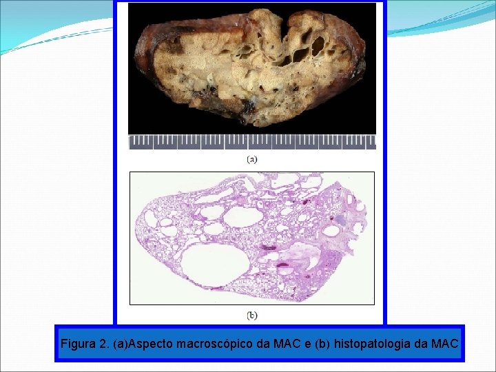 Figura 2. (a)Aspecto macroscópico da MAC e (b) histopatologia da MAC Figura 2. (a)Aspecto macroscópico da MAC e (b) histopatologia da MAC