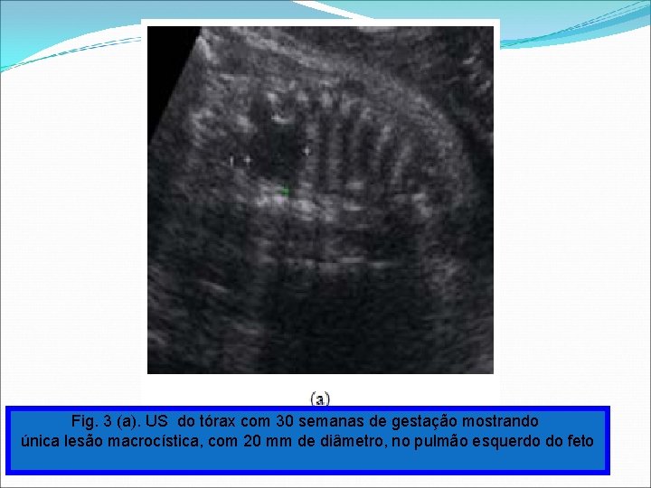 Fig. 3 (a). US do tórax com 30 semanas de gestação mostrando única lesão Fig. 3 (a). US do tórax com 30 semanas de gestação mostrando única lesão