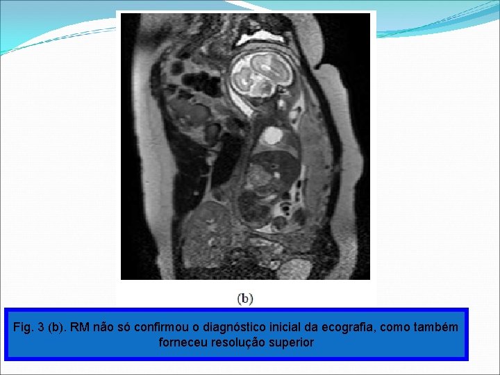 Fig. 3 (b). RM não só confirmou o diagnóstico inicial da ecografia, como também Fig. 3 (b). RM não só confirmou o diagnóstico inicial da ecografia, como também