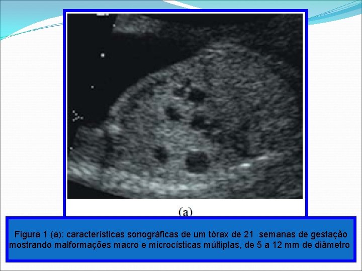 Figura 1 (a): características sonográficas de um tórax de 21 semanas de gestação mostrando Figura 1 (a): características sonográficas de um tórax de 21 semanas de gestação mostrando