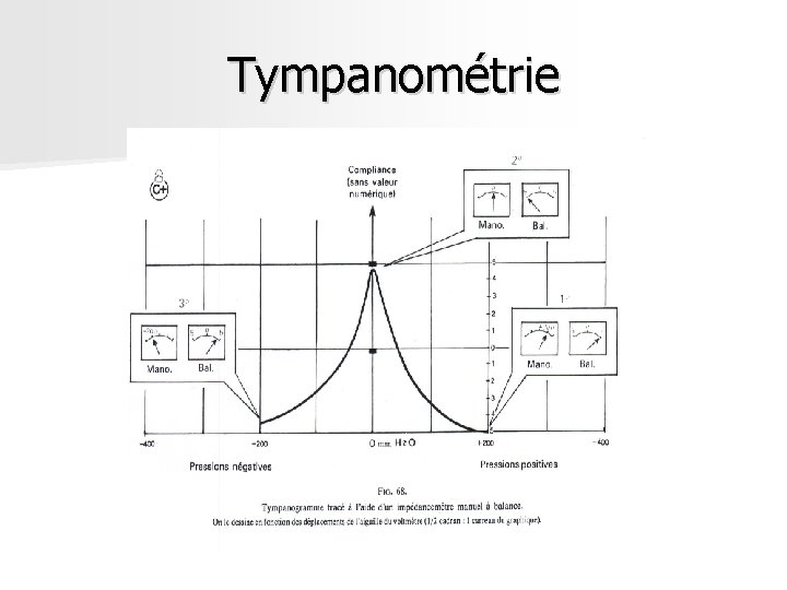 Tympanométrie Tympanométrie