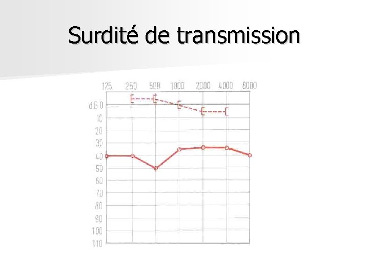 Surdité de transmission Surdité de transmission