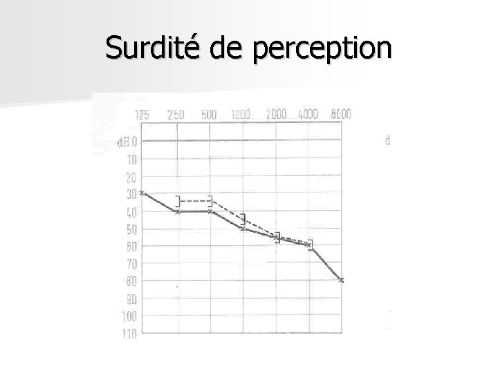 Surdité de perception Surdité de perception