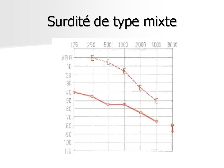 Surdité de type mixte Surdité de type mixte