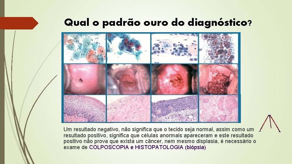 Qual o padrão ouro do diagnóstico? Um resultado negativo, não significa que o tecido