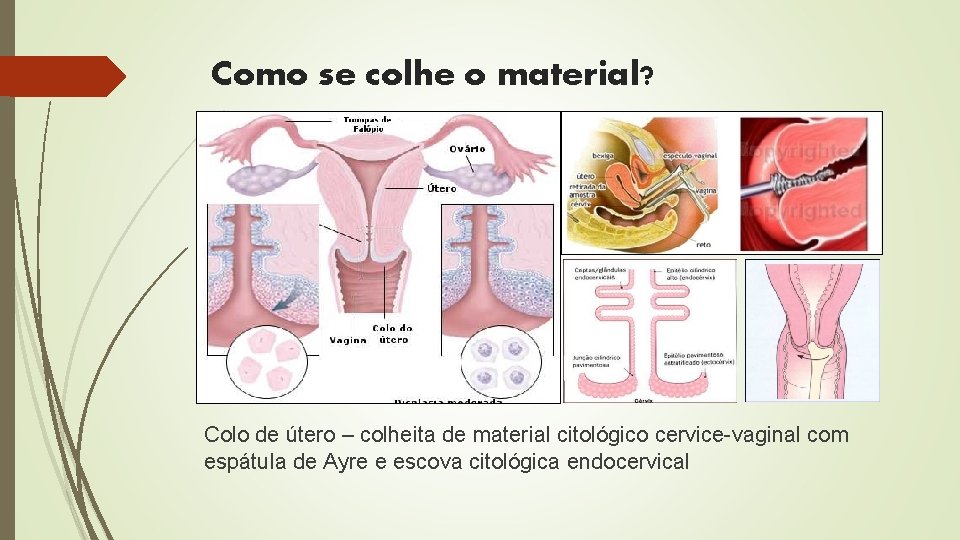 Como se colhe o material? Colo de útero – colheita de material citológico cervice-vaginal