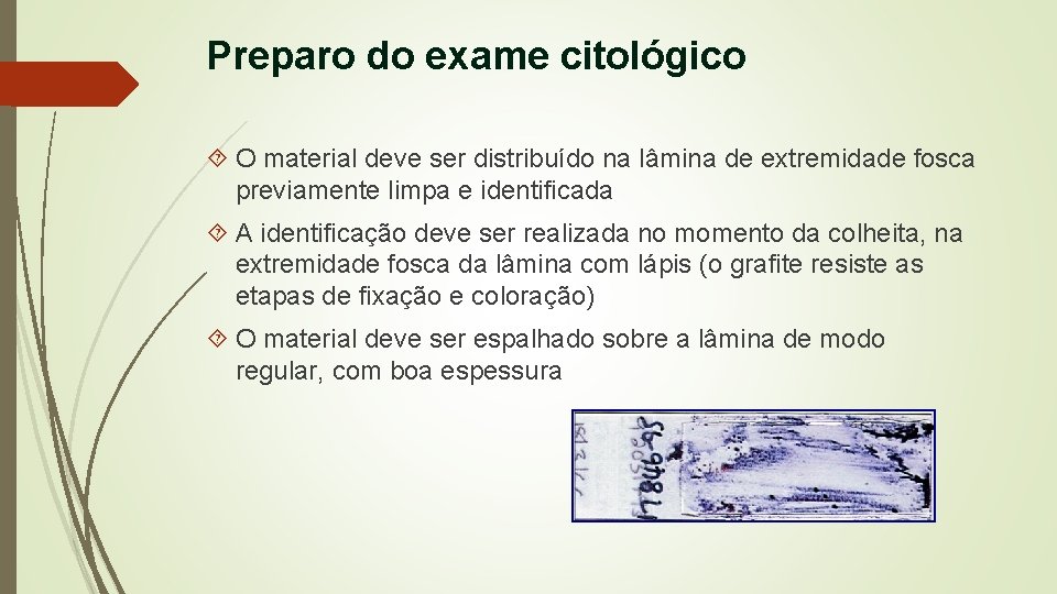 Preparo do exame citológico O material deve ser distribuído na lâmina de extremidade fosca