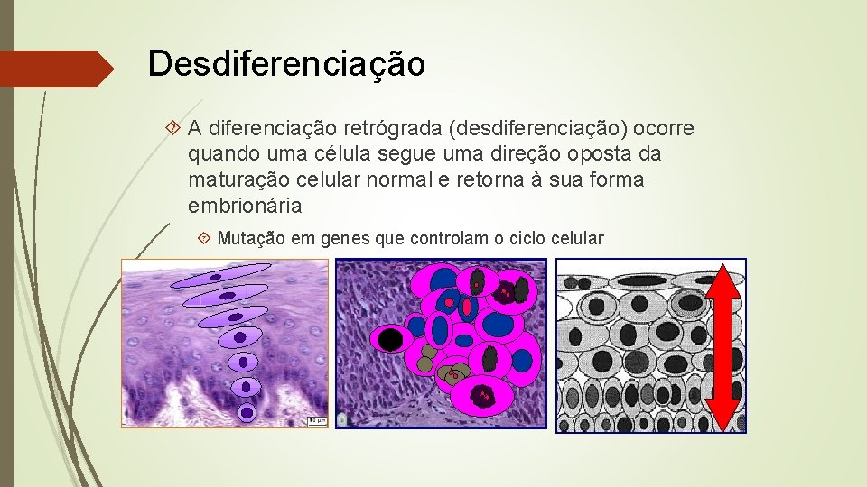 Desdiferenciação A diferenciação retrógrada (desdiferenciação) ocorre quando uma célula segue uma direção oposta da