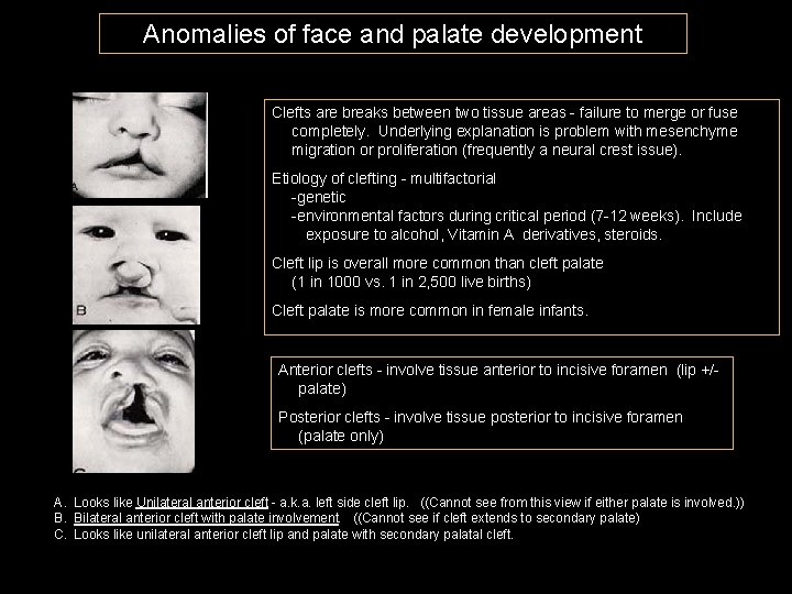 Anomalies of face and palate development Clefts are breaks between two tissue areas -