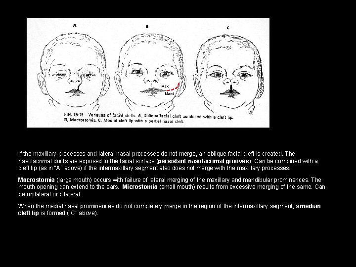 Max Mand If the maxillary processes and lateral nasal processes do not merge, an