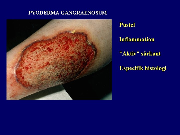 PYODERMA GANGRAENOSUM Pustel Inflammation ”Aktiv” sårkant Uspecifik histologi 