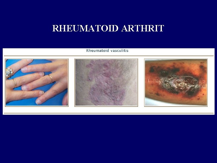 RHEUMATOID ARTHRIT 