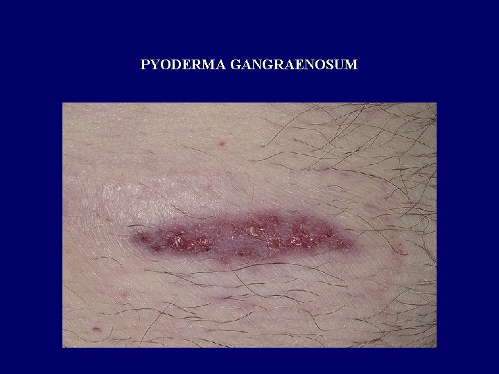 PYODERMA GANGRAENOSUM 