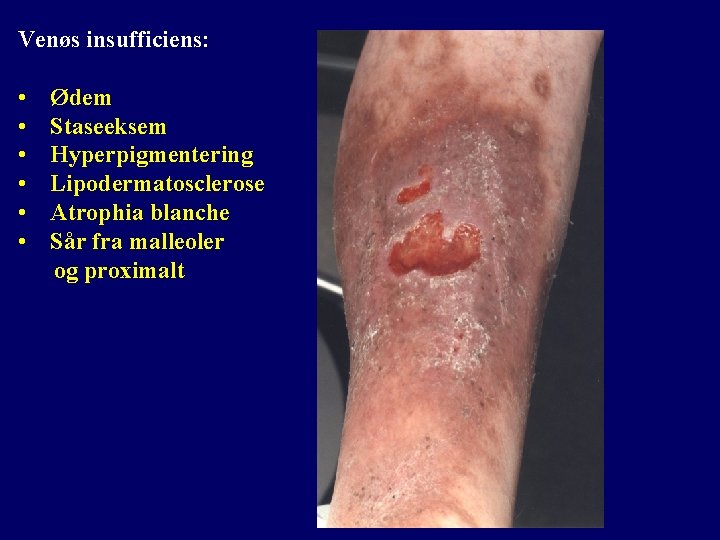 Venøs insufficiens: • • • Ødem Staseeksem Hyperpigmentering Lipodermatosclerose Atrophia blanche Sår fra malleoler