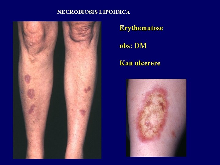 NECROBIOSIS LIPOIDICA Erythematøse obs: DM Kan ulcerere 