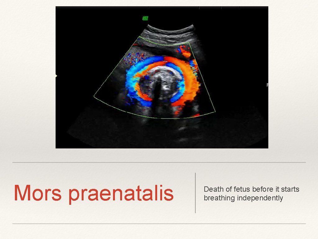 Mors praenatalis Death of fetus before it starts breathing independently 