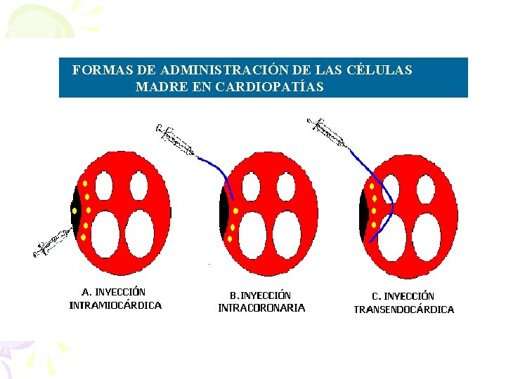 FFORMAS DE ADMINISTRACIÓN DE LAS CÉLULAS MADRE EN CARDIOPATÍAS 