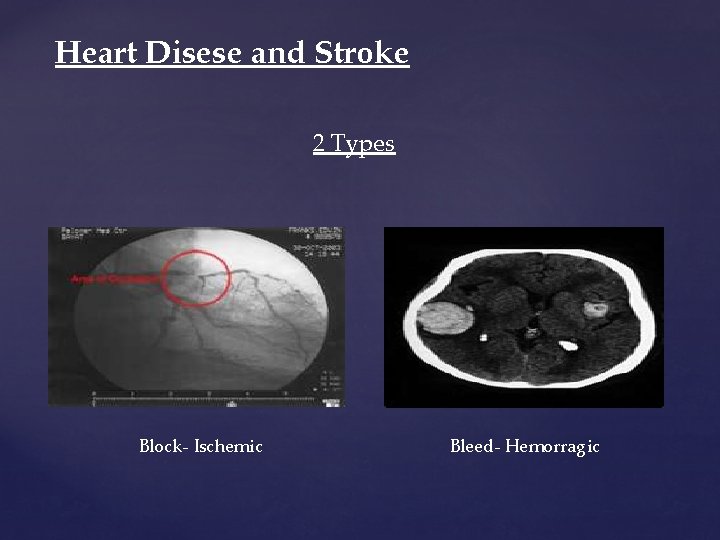 Heart Disese and Stroke 2 Types Block- Ischemic Bleed- Hemorragic Heart Disese and Stroke 2 Types Block- Ischemic Bleed- Hemorragic