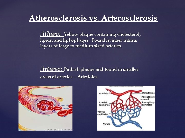 Atherosclerosis vs. Arterosclerosis Athero: Yellow plaque containing cholesterol, lipids, and liphophages. Found in inner Atherosclerosis vs. Arterosclerosis Athero: Yellow plaque containing cholesterol, lipids, and liphophages. Found in inner