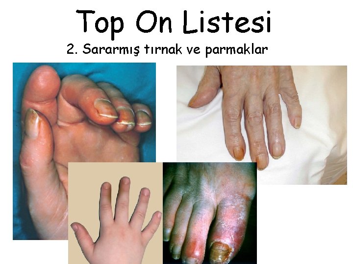 Top On Listesi 2. Sararmış tırnak ve parmaklar 